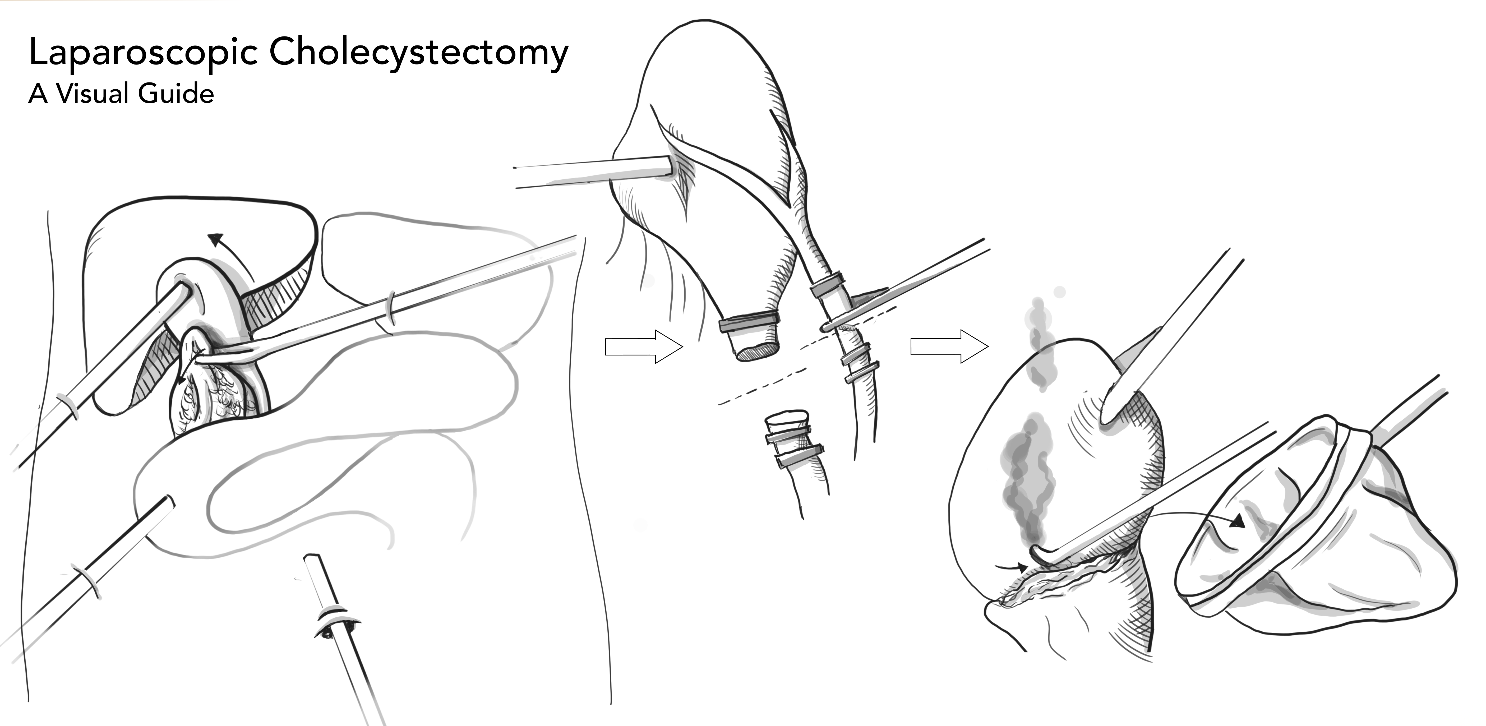 laparoscopic surgery illustration